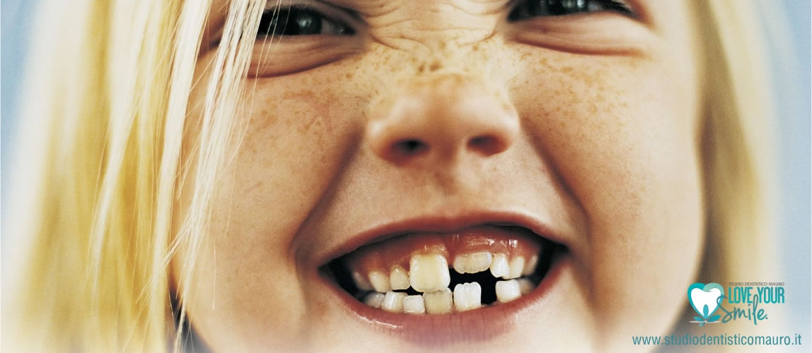 Test: calcola il rischio di carie dentale nel bambino